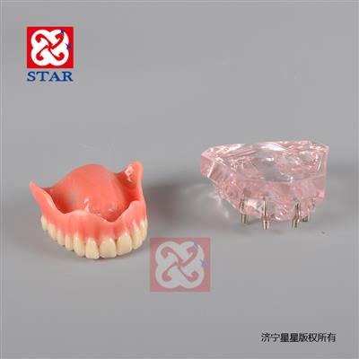4個微型種植釘，上頜一尺修復。M6001